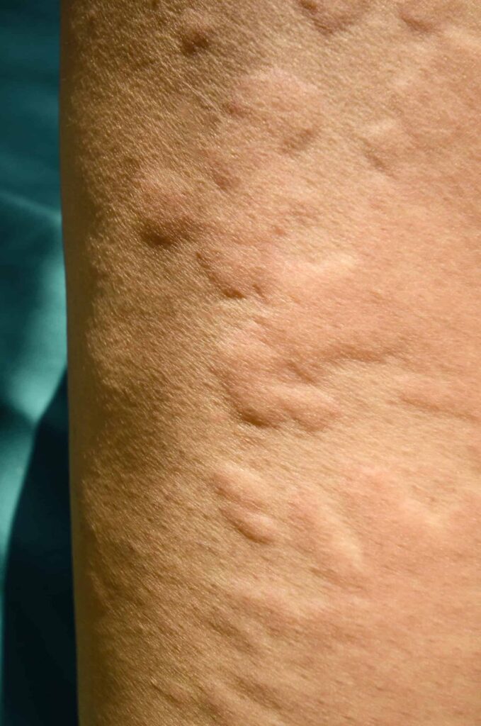 Close-up of an arm with irritated, raised skin.