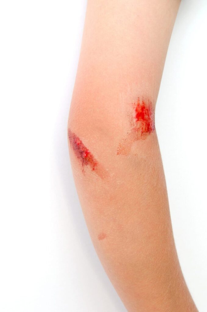 A forearm with fresh scrapes near the elbow.